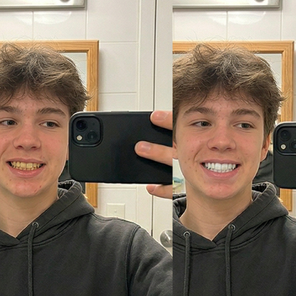QuickWhiten: Purple Teeth Whitening Strips