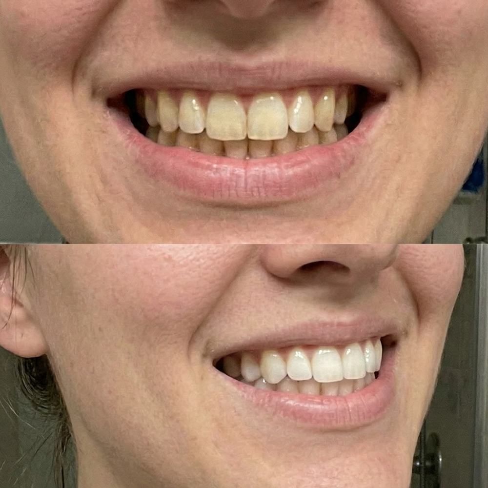 QuickWhiten: Purple Teeth Whitening Strips